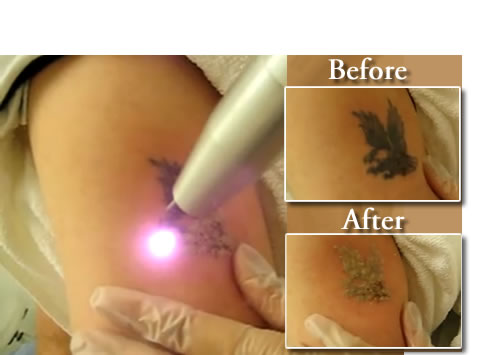 Eliminar un tatuaje antes y despues